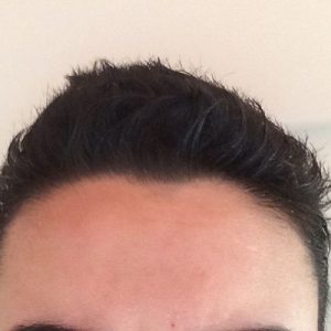 Hair Transplant For Forehead Reduction In Islamabad