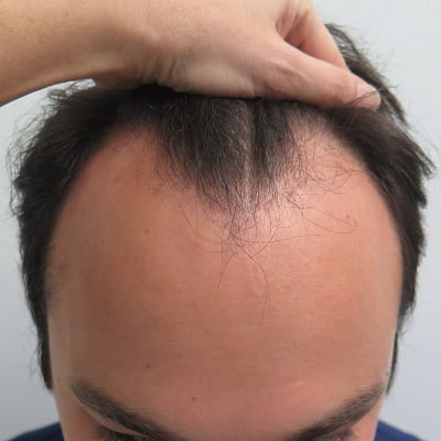 NeoGraft Hair Transplant Cost in Islamabad