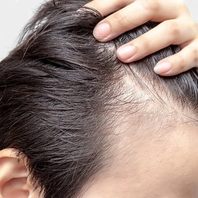 Non-Invasive Hair Transplant in Islamabad and Rawalpindi