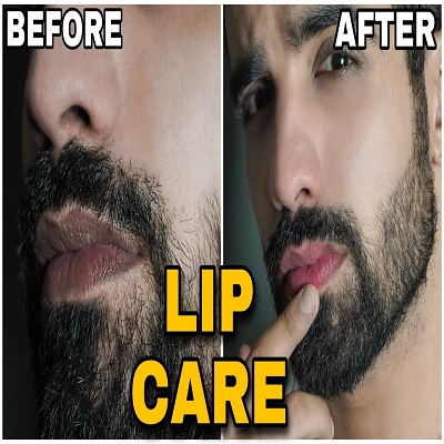 Smoker Lips Treatment In Islamabad, Rawalpindi & Pakistan