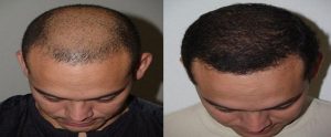 What Is The Best place to Get Hair Transplant in Islamabad
