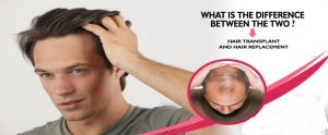 Difference Between Hair Transplant And Hair Replacement