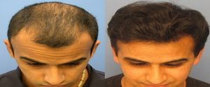 synthetic Hair transplant in Islamabad Pakistan