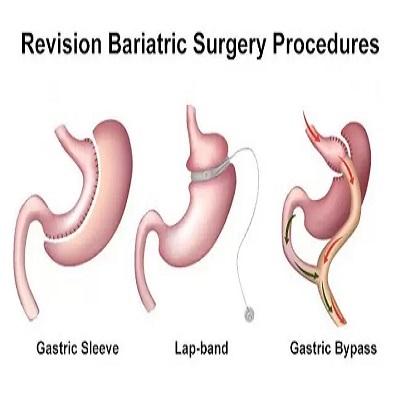 Best Clinic for Bariatric Surgery in Islamabad Pakistan