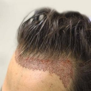 FUE Unshaven Hair Transplant In Islamabad