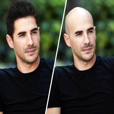 Most Advanced Technology for Hair Transplantation in Islamabad Pakistan