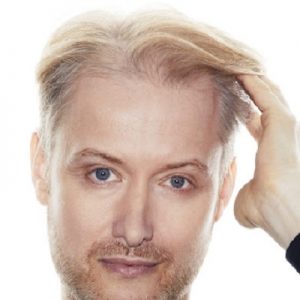 What Are the Best Treatment Options for Thinning Hair