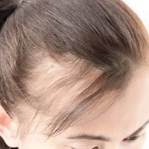 All About Female Pattern Hair Loss