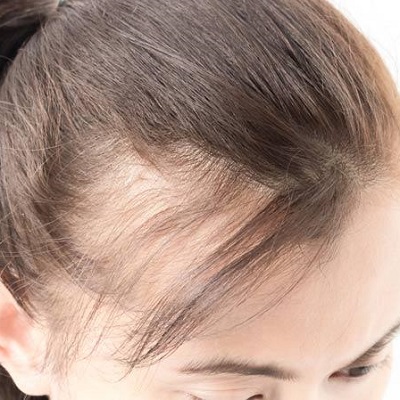 All About Female Pattern Hair Loss