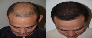 Cheap And Best Hair Transplant In Islamabad