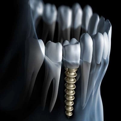 Dental Implants For Missing Teeth in Islamabad