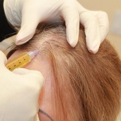 PRP Hair Treatment in Islamabad, Rawalpindi & Pakistan | PRP for Hair Loss