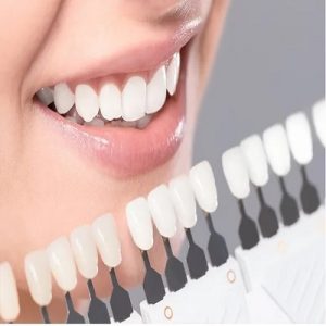 Porcelain Dental Veneers In Islamabad