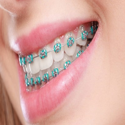 Best Dental Clinic For Getting Braces In Islamabad