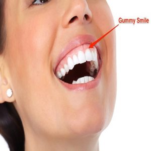 Botox For Gummy Smile In Islamabad Pakistan