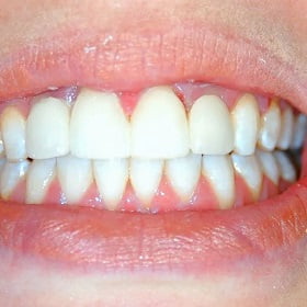 Dental-implants-Islamabad Pakistan