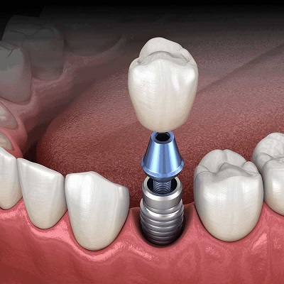 Full Mouth Dental Implant Cost in Islamabad Pakistan