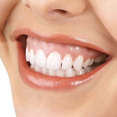Gummy Smile Treatment in Islamabad, Rawalpindi & Pakistan