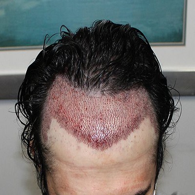 Which Hair Transplant Technique is Best in Pakistan?
