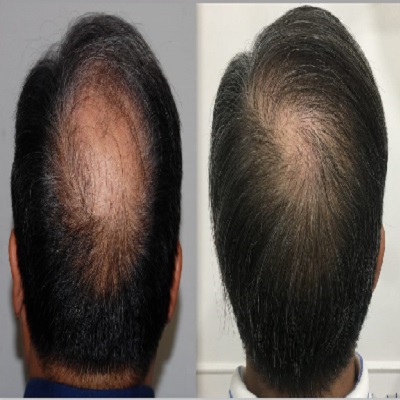How Much Grafts Are Required For Crown Hair Transplant