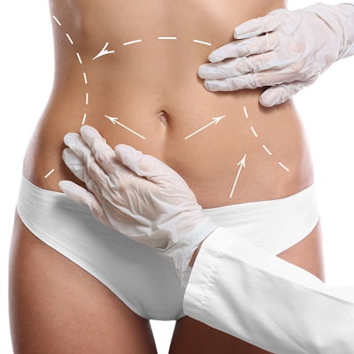 How Much Weight Can You Lose with Liposuction