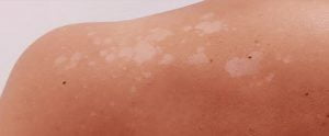 How to Get Rid of White Spots on Skin from Sun