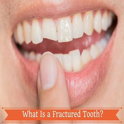 Teeth Fracture Treatment in Islamabad, Rawalpindi & Pakistan