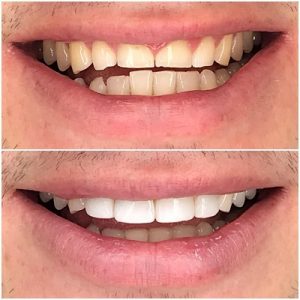 Tooth Bonding Cost in Islamabad Pakistan