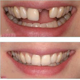 single-tooth-implant in Islamabad