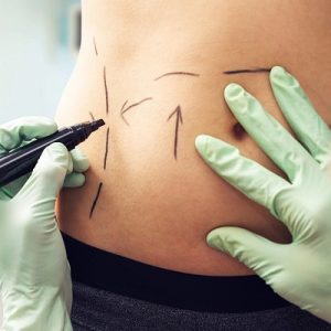 Best Liposuction Doctor In Islamabad