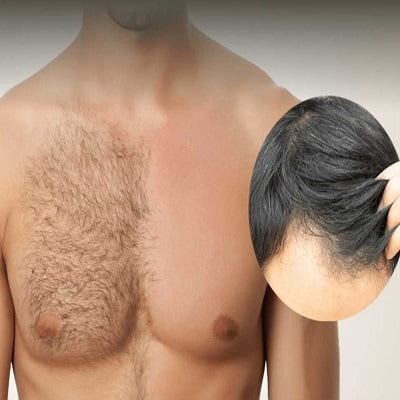 Body Hair Transplant in Islamabad, Rawalpindi & Pakistan