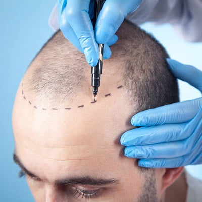 Can Hair Transplant Cause Cancer