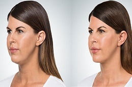 Double Chin Liposuction in Islamabad, Rawalpindi Pakistan before after