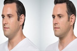 Double Chin Liposuction in Islamabad, Rawalpindi before & after