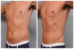 High Definition Liposculpture in Islamabad Pakistan before after