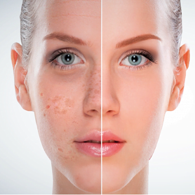 Laser Pigmentation Treatment in Islamabad, Rawalpindi & Pakistan