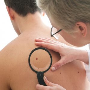 Mole Removal Cost in Islamabad