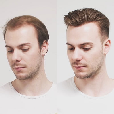 Non Surgical Hair Replacement in Islamabad, Rawalpindi & Pakistan - SKN