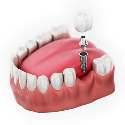 Dental Implants in Islamabad, Rawalpindi, Pakistan