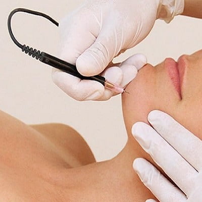 Electrolysis Laser Hair Removal Islamabad