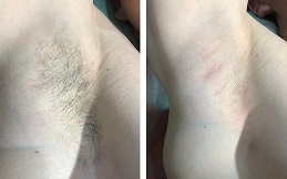 Electrolysis Laser Hair Removal Islamabad