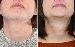 Electrolysis Laser Hair Removal cost in Islamabad