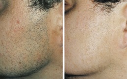 Electrolysis Laser Hair Removal in Islamabad