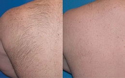 Electrolysis Laser Hair Removal in Pakistan