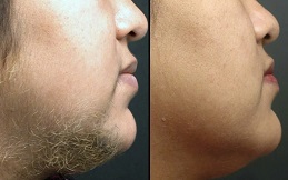 Electrolysis Laser Hair Removal results in Islamabad