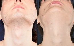 Electrolysis Laser Hair Removal