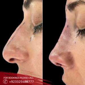 Nose Surgery Price in Pakistan