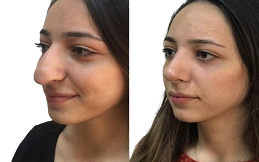Nose Surgery in Islamabad,Pakistan