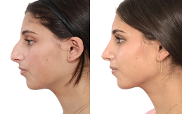Nose Surgery price in Islamabad