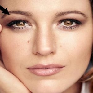 Botox Brow Lift for Hooded Eyes